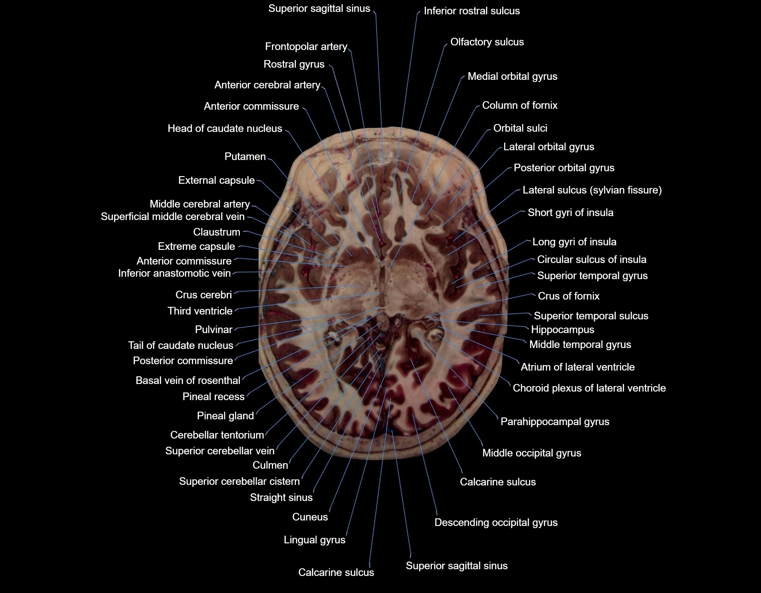 MRI Brain axial cross sectional radiology anatomy 3T image  -img-000039.webp